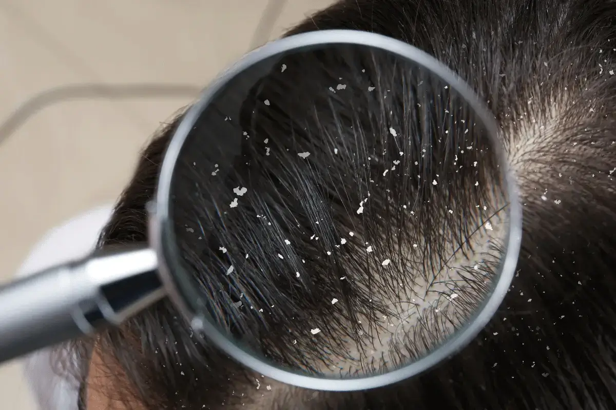 Dandruff treatment